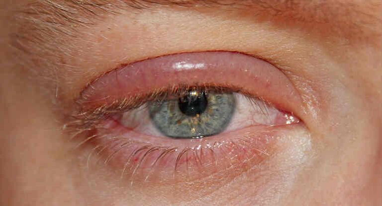 Demodectic ringworm on the eyelids