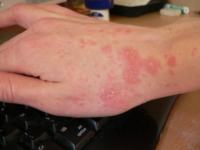 Human hands are affected by scabies